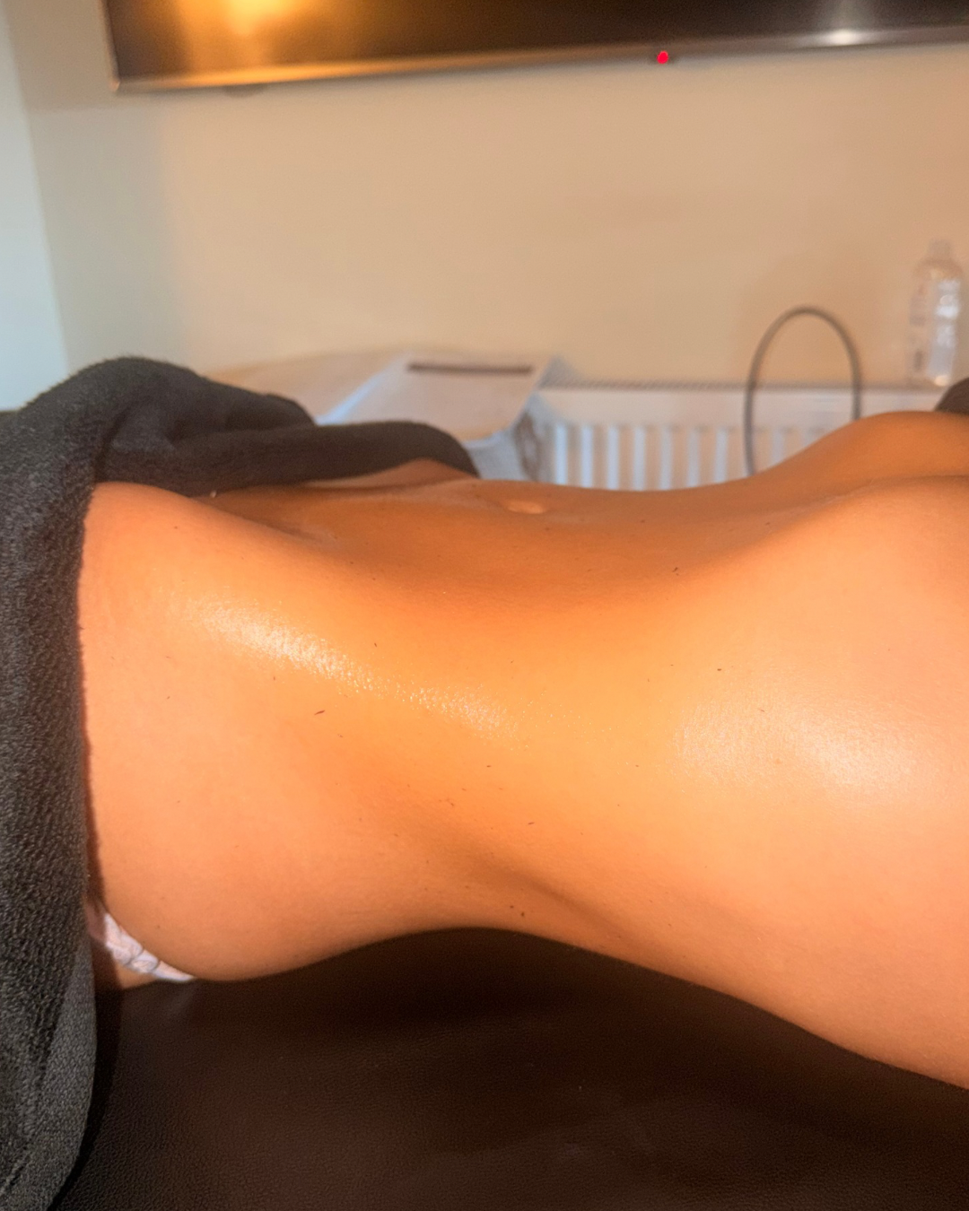 Sculpted abdomen after lymphatic drainage body contouring treatment