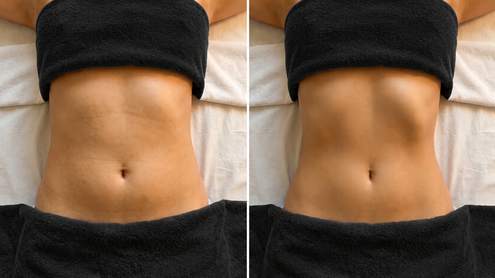 Body contouring before and after treatment