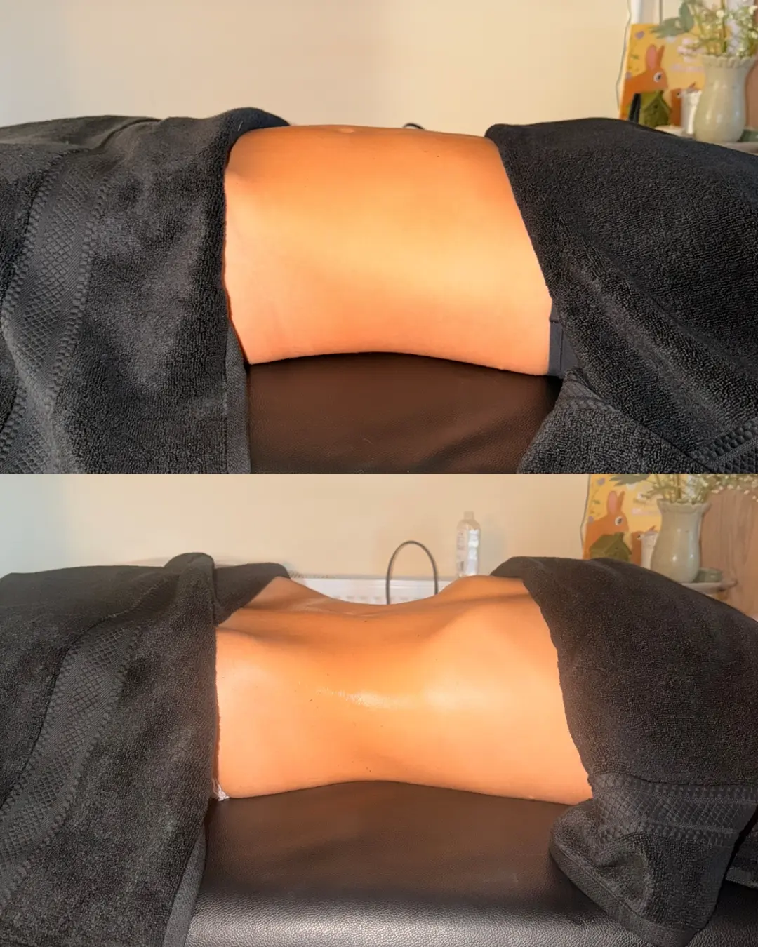 Before and after lymphatic drainage and body contouring treatment