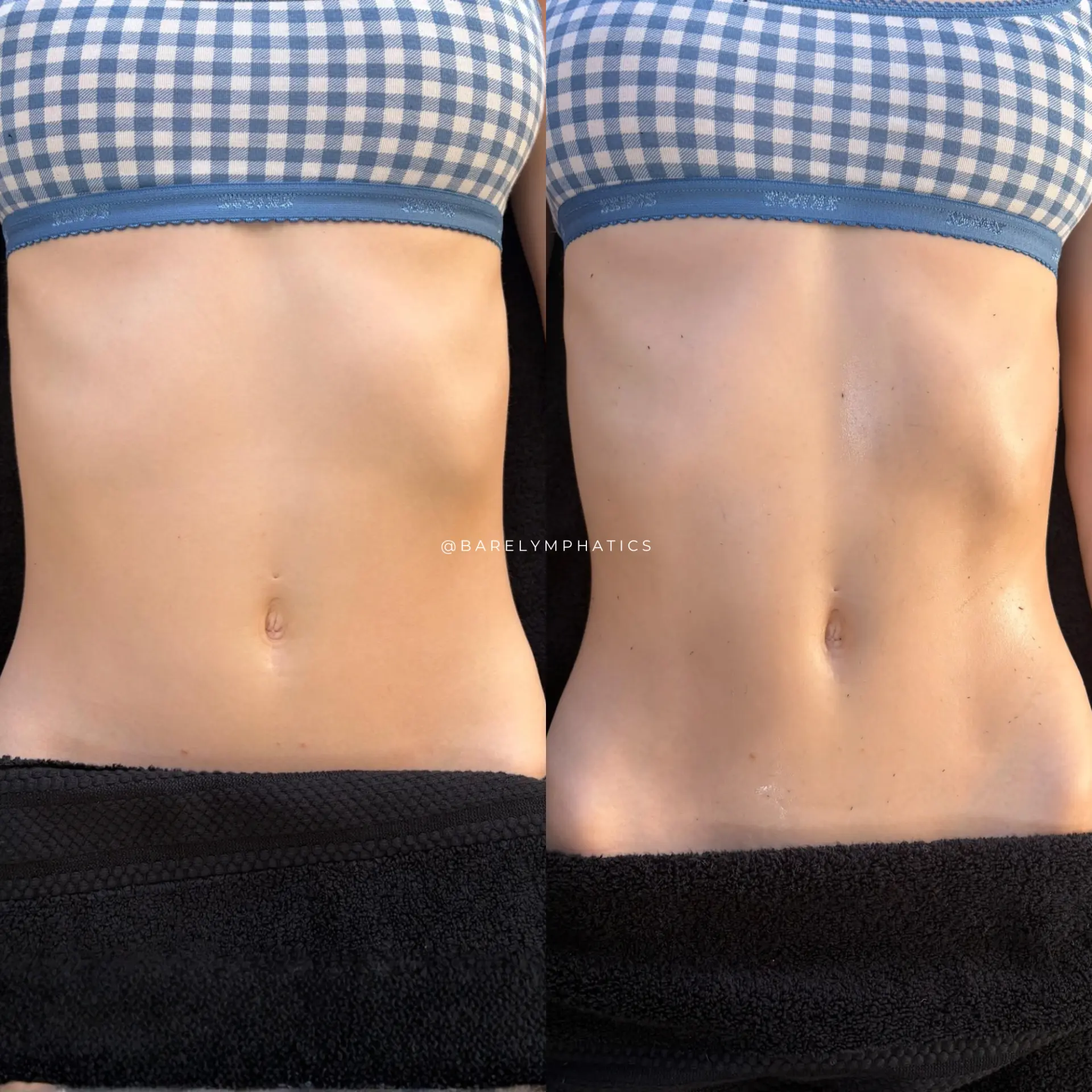 Abdomen before and after a course of lymphatic drainage sessions