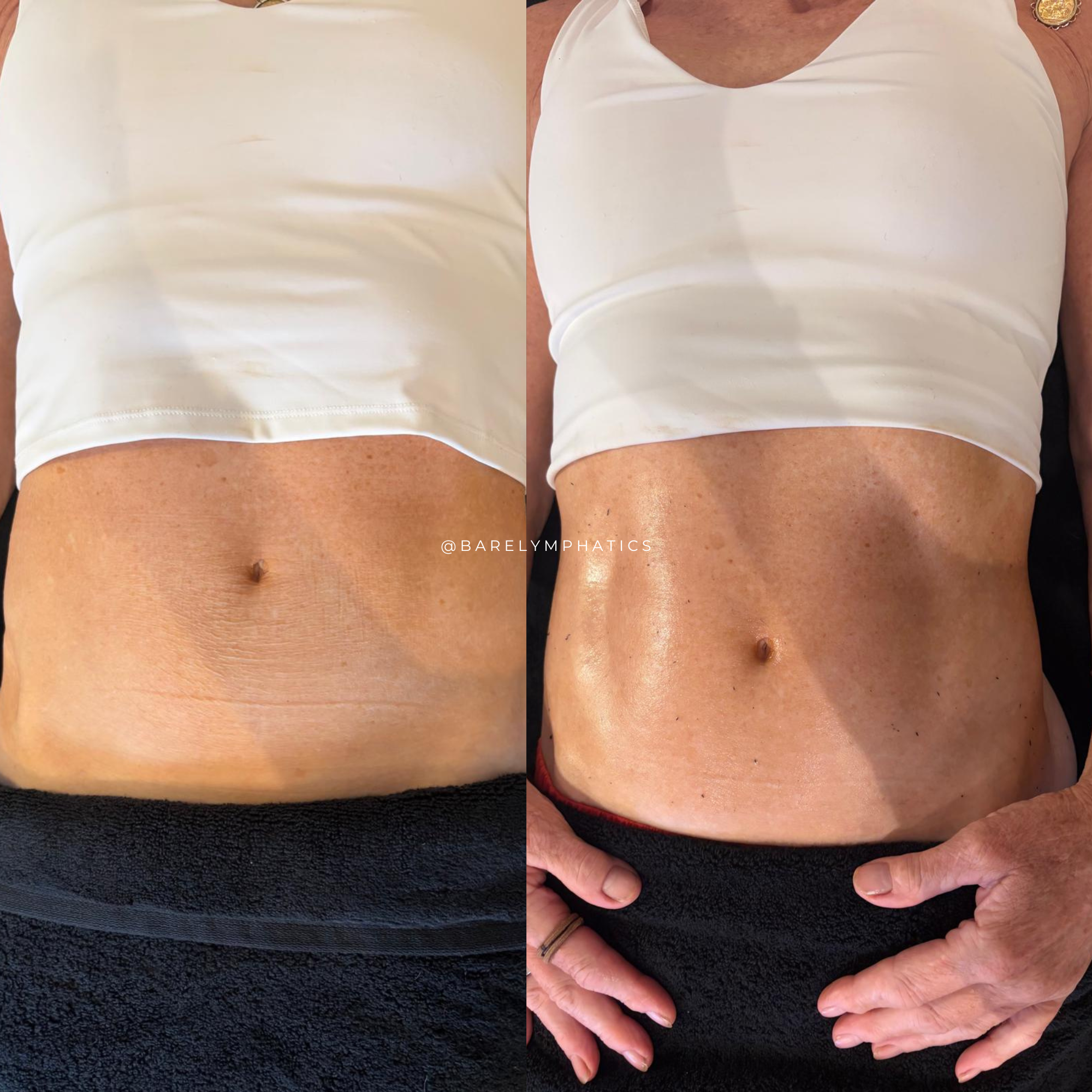 Abdomen before and after lymphatic drainage and wood therapy treatment